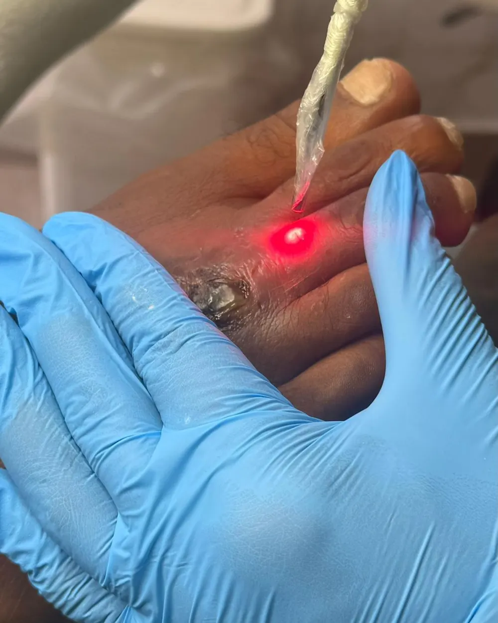 Aplicação de laserterapia de baixa potência no dedo do pé