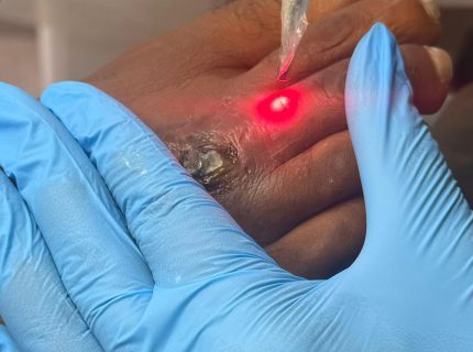 laserterapia